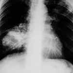 rak-pluca