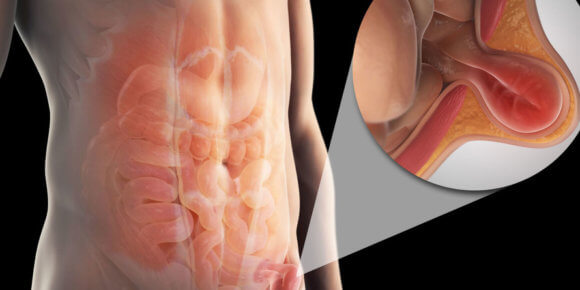 preponska-kila-naslovna-580x290