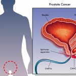 kancer prostata