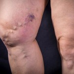 Uz pomoć ove BILJKE: Izliječite proširene vene na potpuno prirodan način